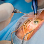 Cataract Eye Surgery: Procedure, Benefits and Risks